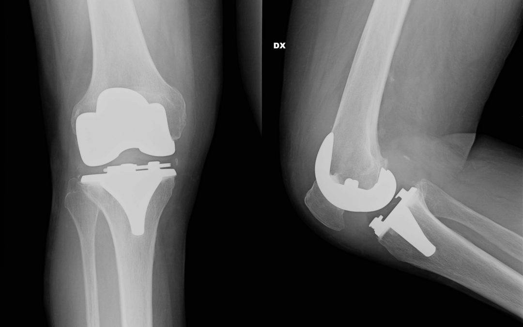 La chirurgia correttiva delle deformità assiali degli arti inferiori