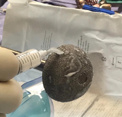 Infezioni periprotesiche, rischio ridotto grazie ad un gel innovativo